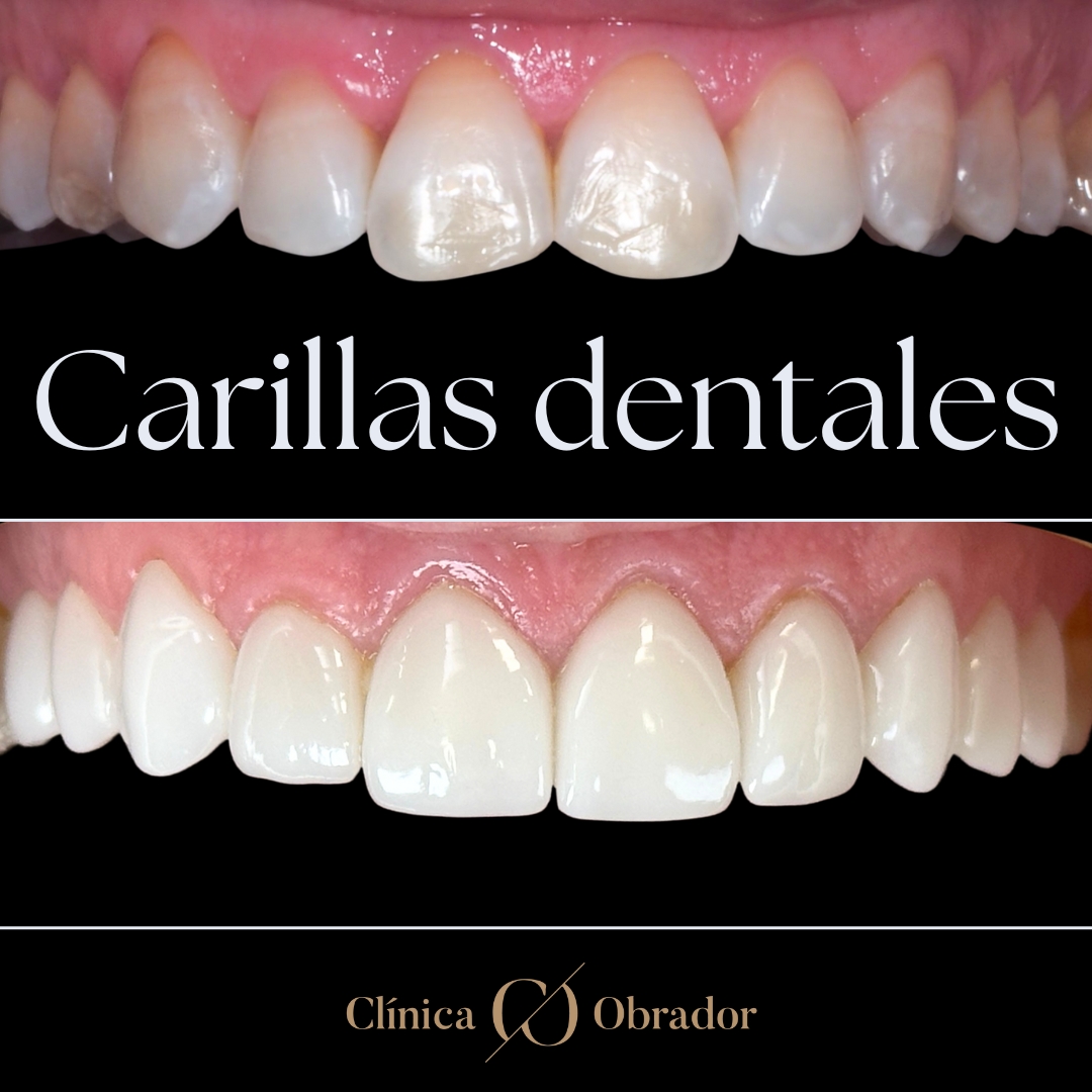 carillas dentales